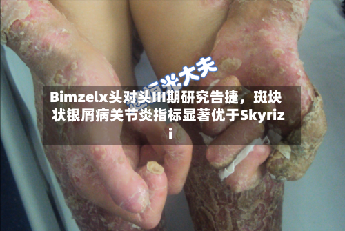 Bimzelx头对头III期研究告捷,斑块状银屑病关节炎指标显著优于Skyrizi